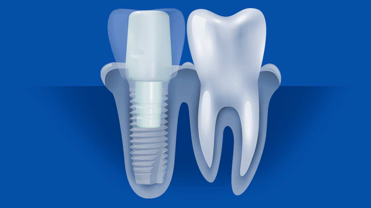 Ceramic Dental Implant Abutment Diagram