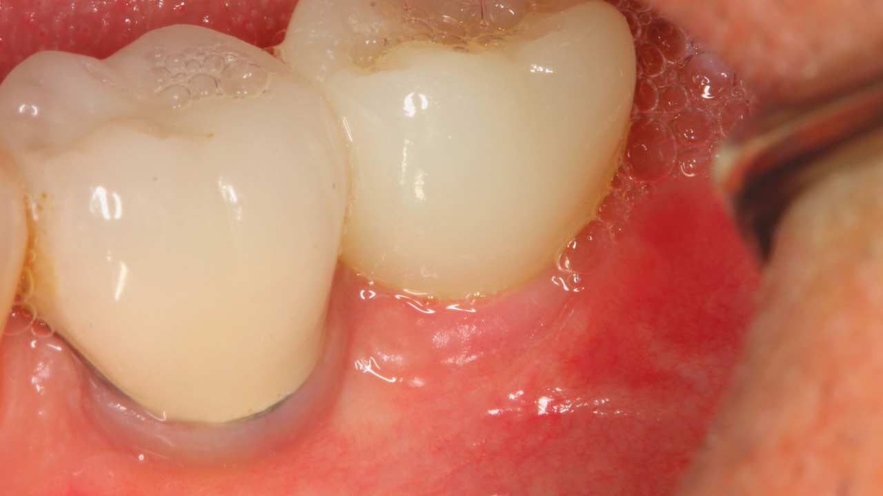 Ceramic Dental Implants Before and After