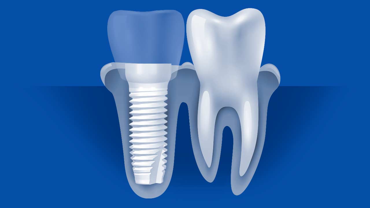 Ceramic Dental Implant