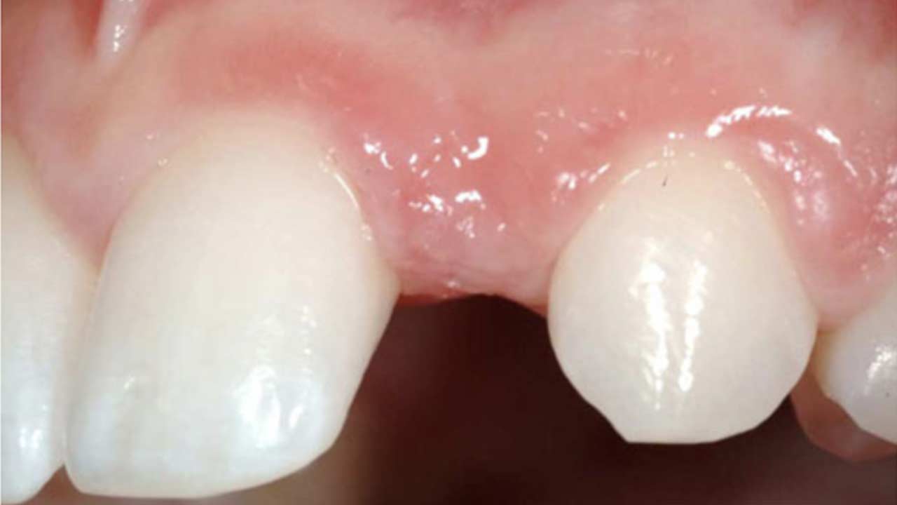 Ceramic Dental Implant Before and After