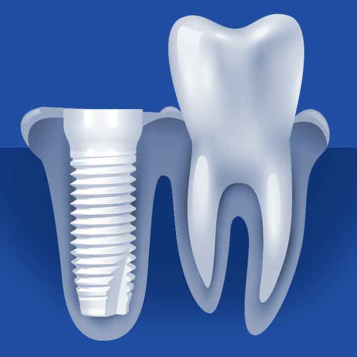 Ceramic Dental Implant Process Step One