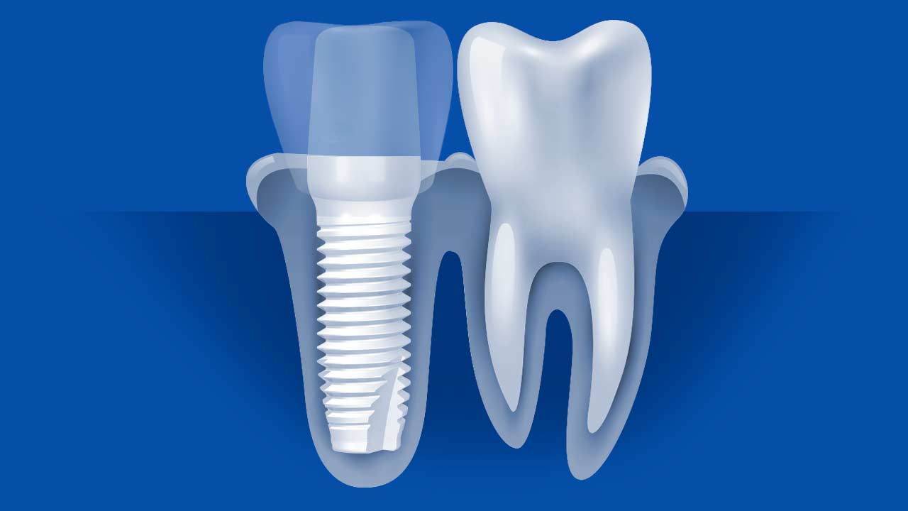 Ceramic Dental Implant Screw Diagram